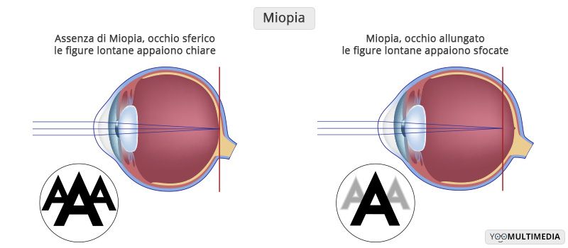 Miopia: descrizione, sintomi e cure centro oculistico Florence Medical Center Firenze